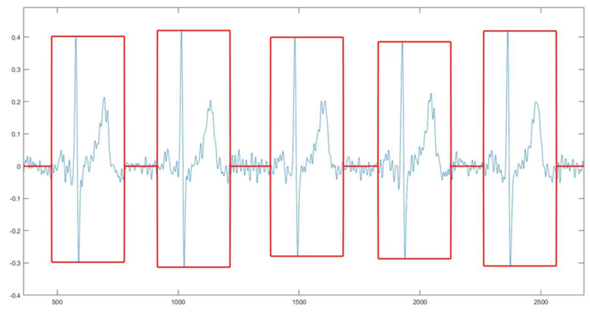 Feature extraction from ECG signals